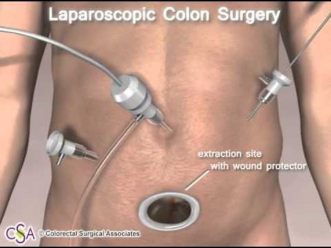 Laparoscopic Colon Surgery-Colorectal Surgical Associates