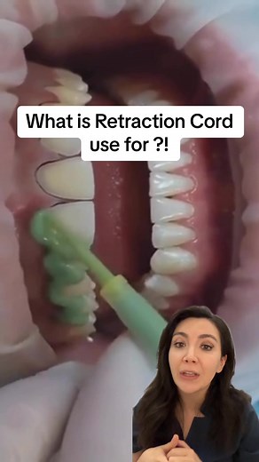 Why Dentists Use Retraction Cords for Better Impressions