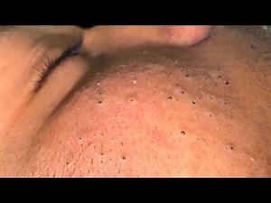 Deep Cleansing Techniques for Acne - Blackhead Removal and Facial Care Routine