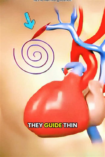 How Pacemaker Insertion Procedure Is Performed (3D Animation) #3dmedicalanimation #medical3danimation #pacemaker #heartsurgery #hearthealth