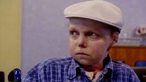 The Boy Whose Skin Fell Off