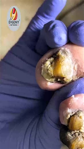 Top Strategies to Help Working Professionals Prevent Ingrown Toenails #NonCuttingMethod #SafeNailCare #FootHealthUSA #ThickToenailCare | Evgeniy