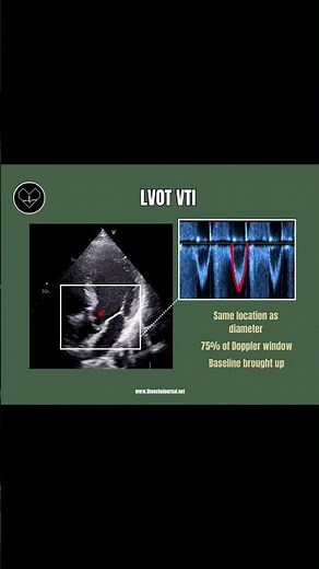 LVOT VTI (V₁)