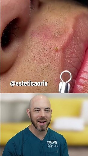 Pimple in the Most Painful Spot? Watch This Gentle Extraction