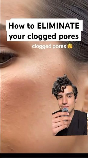Derm reveals how to treat your clogged pores #cloggedpores #pores #dermatologist #whiteheads