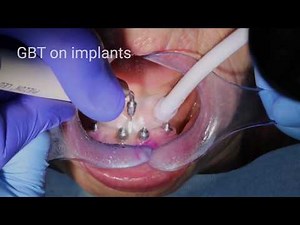 Implant maintenance with AIRFLOW® and the PI Instrument