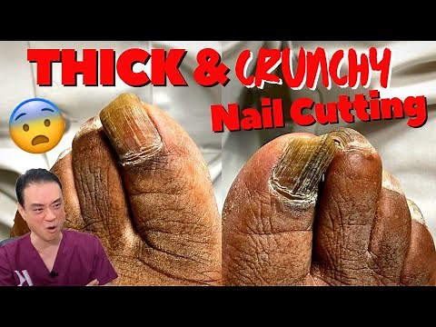 SUPER LONG, THICK, CRUNCHY TOENAIL CUTTING!! *Oddly Satisfying* | Dr. Kim