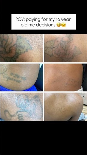Only regret I have is not starting this process sooner. Laser tattoo removal process.