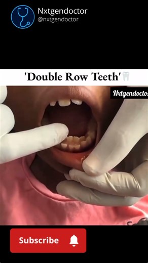Double Row Teeth – Myth or Medical Condition?”#DoubleRowTeeth #SharkTeeth#DentalFacts #viralshorts🤯