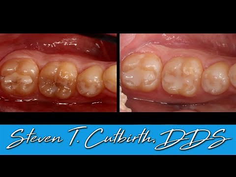 Replacing Leaky Composite Fillings - Dental Minute with Steven T. Cutbirth, DDS