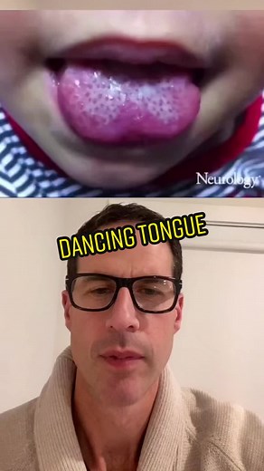 What is a Dancing Tongue? Tongue Fasciculations in Babies Explained