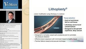 Atherectomy for Superficial Femoral Artery Disease