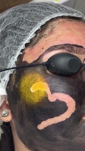 Carbon pilling treatment at twacha clinic by dermatologist dr megha modi