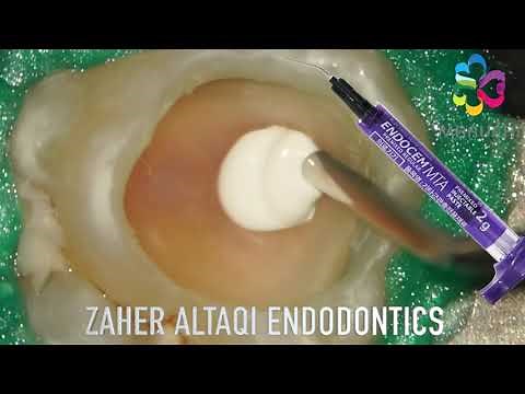 Pulp capping with Endocem MTA premixed