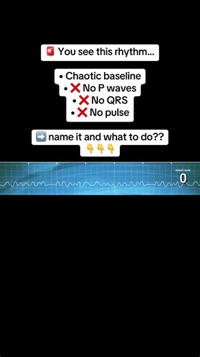 This rhythm is Ventricular Fibrillation (VF) ⚡ How to recognize it FAST ⏱️ • Disorganized electrical activity • No identifiable P waves or QRS complexes • No effective cardiac output 🧠 What this means: The heart is quivering, not pumping. 🚨 Immediate priorities: ✔️ High-quality chest compressions ✔️ Early defibrillation ✔️ Minimize interruptions ✔️ Follow ACLS cardiac arrest pathway Key reminders 👇 • Shockable rhythm • CPR first — don’t delay compressions • Treat the rhythm and the patient Sa