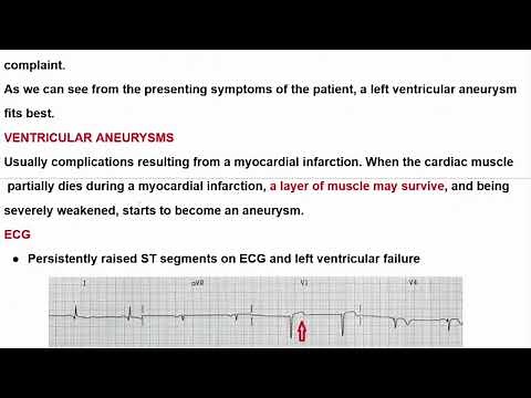 Exploring Left Ventricular Aneurysm on ECG and Chest X-Ray🫀📉🩺