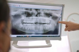 7 Signs Your Wisdom Teeth Need to Come Out - Kelmscott Dental