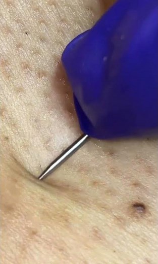 Blackheads 2021 New, Pimple Popping 2021 Removal & Acne Treatment P257