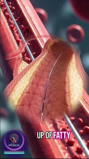 Heart Artery Blocked? See How Angioplasty Fixes It!