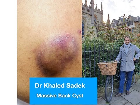 Massive Sebaceous Cyst. LipomaCyst.com Dr Khaled Sadek