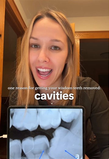 Top Reasons for Wisdom Teeth Removal Explained