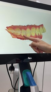 #จัดฟัน #invisalign #teeth #ฟีดดดシ #โฟกัส | invisalign teeth