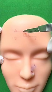Bilateral advancement flap for forehead reconstruction: excision (part 2). Don’t forget to look at Amazon link in bio for my new suture pad! | Dermhacks