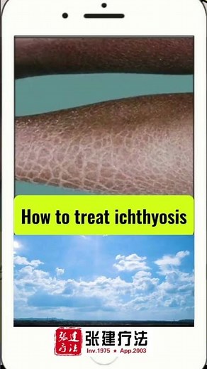 How to treat ichthyosis? #ichthyosistreatment #ichthyosis #ichthyosisvulgaris​ #lamellarichthyosis