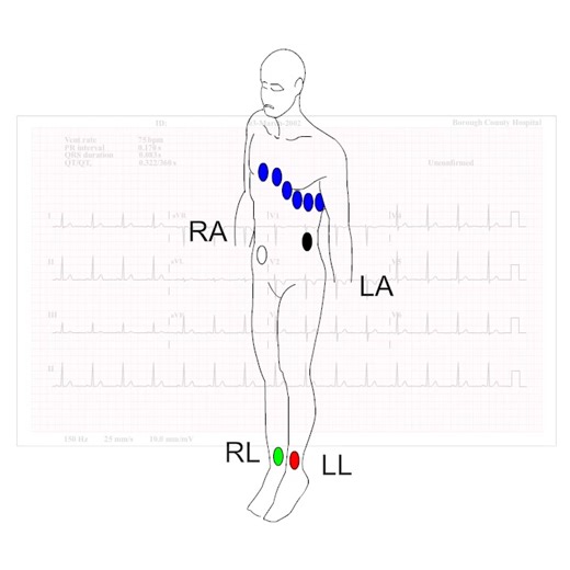 How to Spot Electrode Misplacement - Learn more at https://acadoodle.com #emergencymedicine #intensivecare #respiratory #respiratorycare #icu #nurses #icunurse #ecg #ekg #cme #cmeonline | Acadoodle