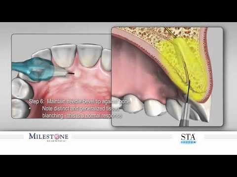 P-ASA Injection| The Wand