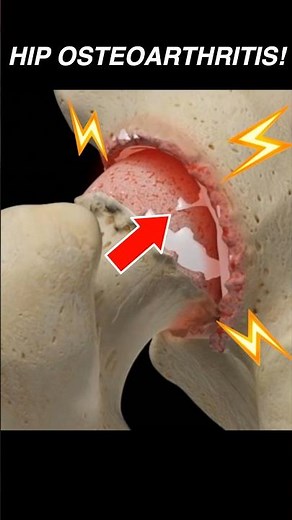 Doctor Explains: Hip OSTEOARTHRITIS 🦴💢