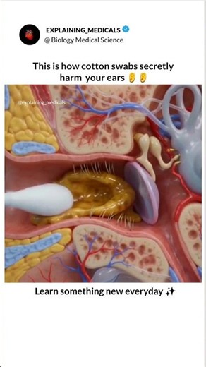 Risk of Using Cotton Swabs...#CottonSwab #EarHealth #EarWax #EarCare #EarSafety #HealthyEars #Hears