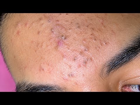 Relaxing Skincare Routine Deep Pore Cleansing & Acne Treatment (So Satisfying)
