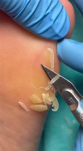 Thick Dry Heel Callus Removal Using Scalpel Satisfying ASMR #asmr #satisfying #podiatry #peliculas