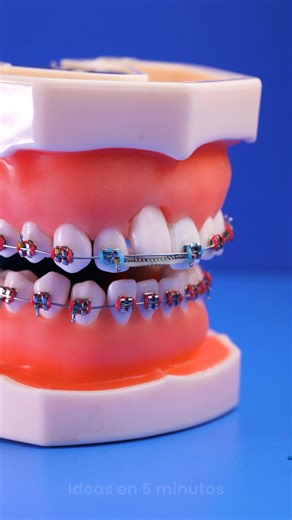 Up-Close Braces Installation | Ideas en 5 minutos