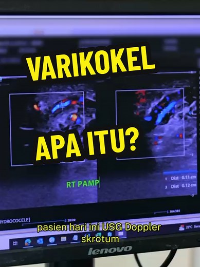 Mengatasi Varikokel: Gejala dan Tindakan Medis