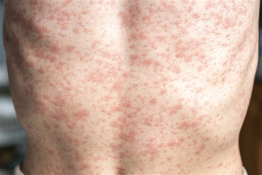NCDHHS: Someone with measles traveled through Gaston County