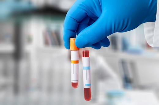 Voici le taux de cholestérol à ne pas dépasser pour éviter l'AVC