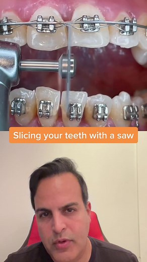 Understanding Interproximal Reduction in Orthodontics