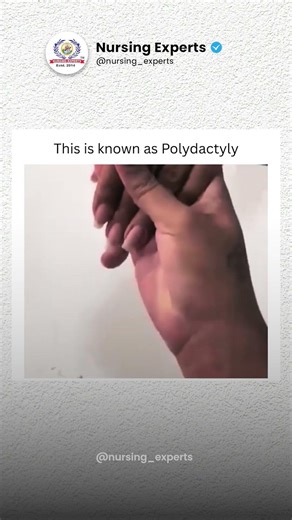 What is Polydactyly? | Congenital Anomaly Explained | Nursing Experts