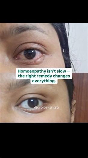 Follow- simple, pattern-based homoeopathy clarity. Result in stye in just 1 day without antibiotics.