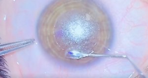 Stages of Lenticule Surgery With the SMILE Pro Device - Eyetube
