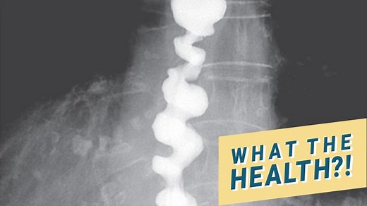 Everything You Should Know About Corkscrew Esophagus