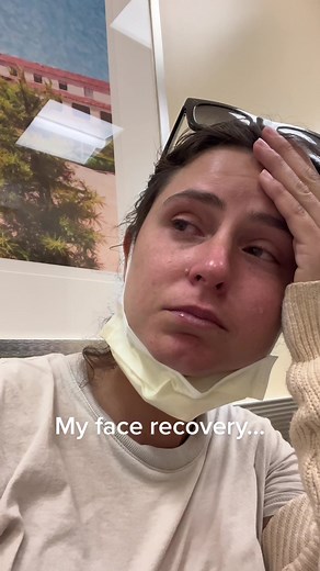 From last year to now. #bellspalsy #bellspalsyrecovery