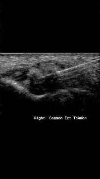Hydroxyapatite Deposition Disease, involving the common extensor tendon of the right elbow.
