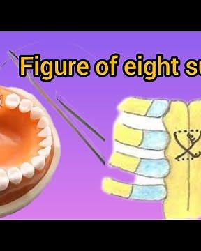 figure of 8 suture - figure of eight suture -suturing technique