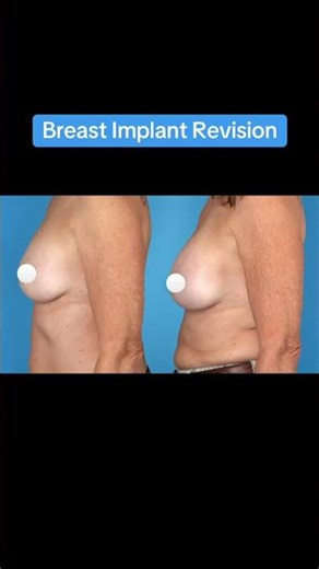 Before & After - Breast Implant Revision