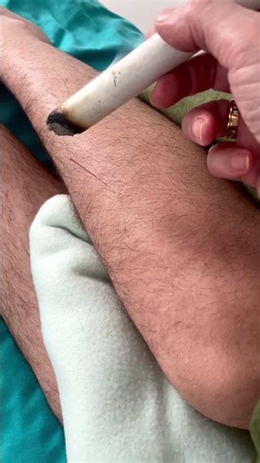 Using Moxa to improve immunity