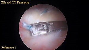 Linked Double-Row Construct Rotator Cuff Repair using all-PEEK Anchors