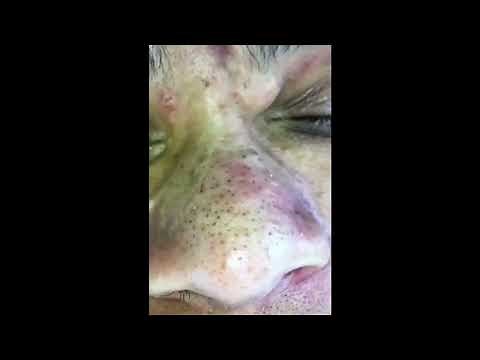 NOSE BlackHeads Extracted (Blackheads Removal Videos 2022) / #4